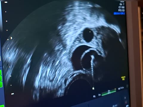 A real ultrasound screen during egg collection in IVF: dark round follicles and the bright line of the needle
